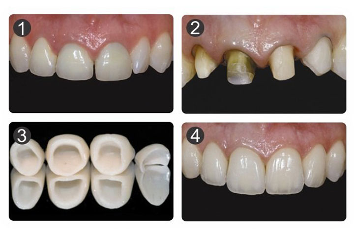 Поставить зубы. Коронка диоксид циркония и металлокерамика. Диоксид циркония коронки. Безметалловая керамика а2 с а1. Коронка диоксид циркония в полости рта.