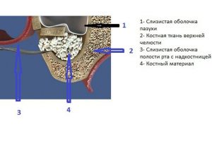 синуслифтинг