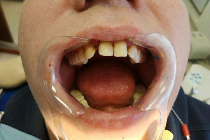 Протезирование фронтальных зубов металлокерамическими коронками