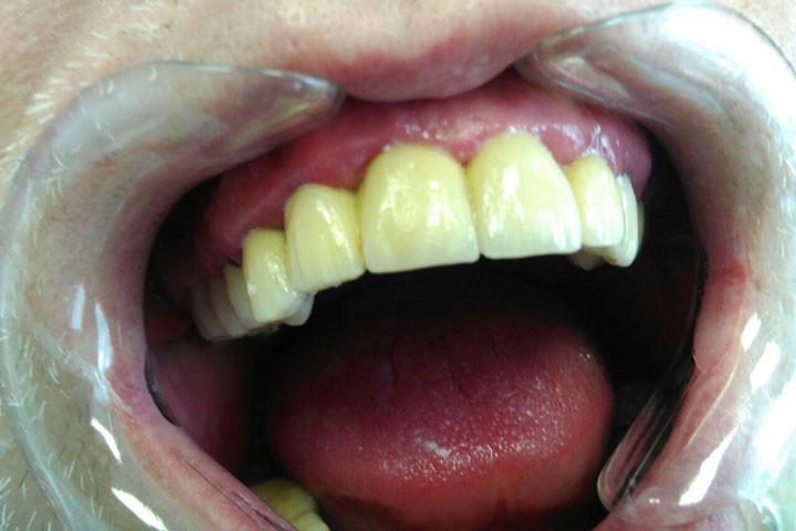 Протезирование фронтальных зубов металлокерамическими коронками
