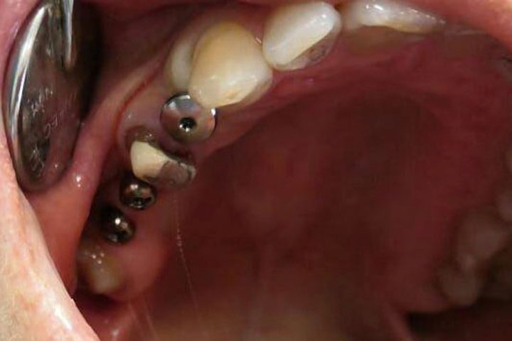 Восстановление зуба вкладками